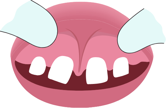 Illustration of a mouth with a lip tie between the two front teeth