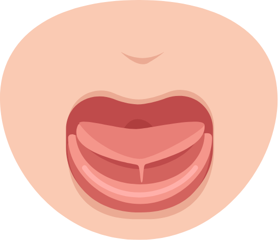 Illustration of a babys mouth with a tongue tie