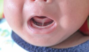 closeup of a baby with a tongue-tie